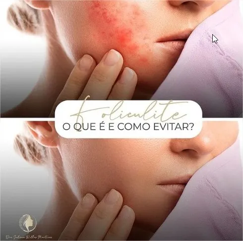 O que provoca a foliculite?