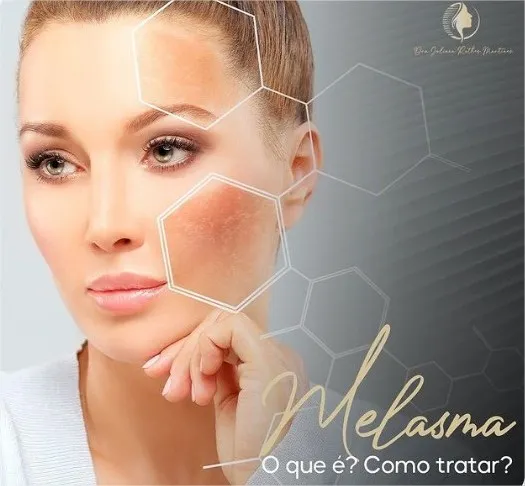 Qual é a causa da melasma?